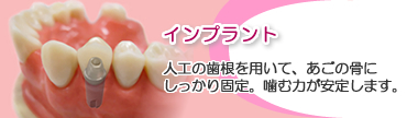 インプラント